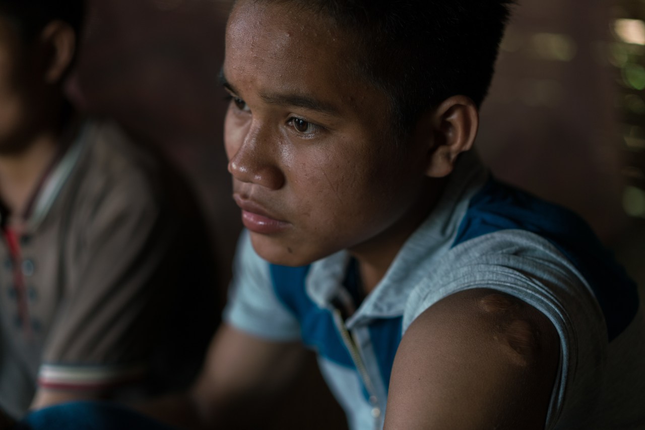 Ty shows the scars on his ear and arm caused by the explosion of the UXO.