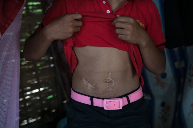 1. A group photo of the boys who were injured: Luu, Ty, Ming, and Mae. / 2. Luu shows the scars on his abdomen caused by the cluster bomb explosion.